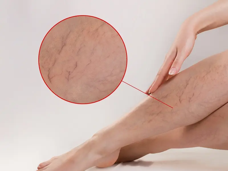 Заболевания системы кровообращения